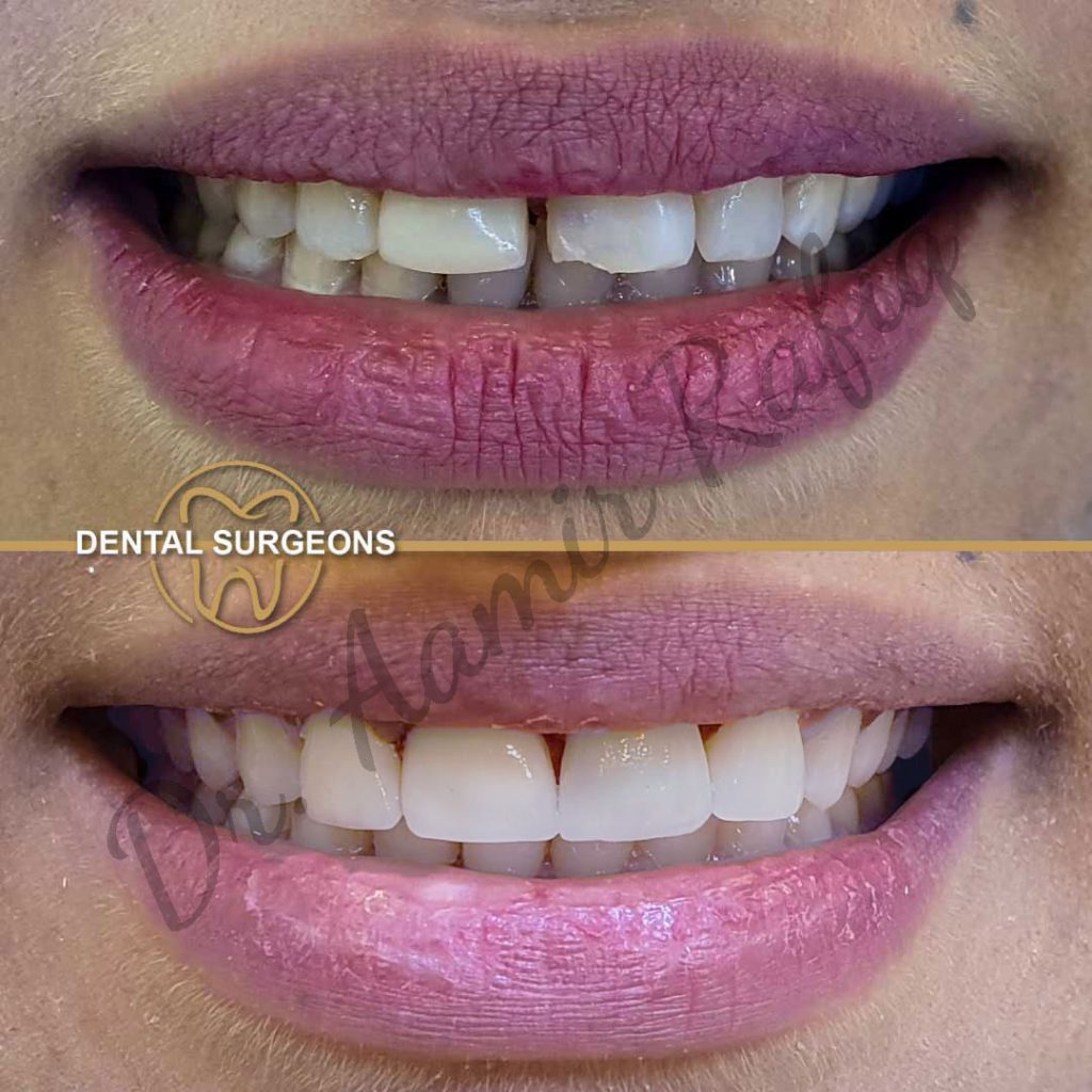 Cosmetic Bonding Case 1 Dental Surgeons Clinic Lahore