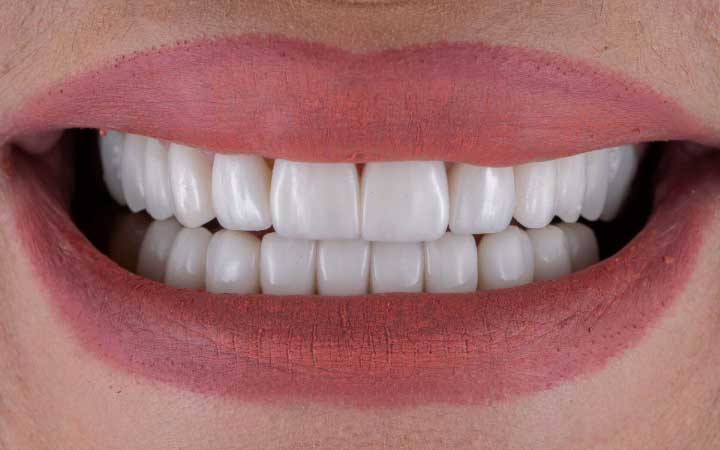 Dental Veneers in Lahore | Dental Surgeons high quality affordable composite veneers at Dental Surgeons Gulberg Lahore