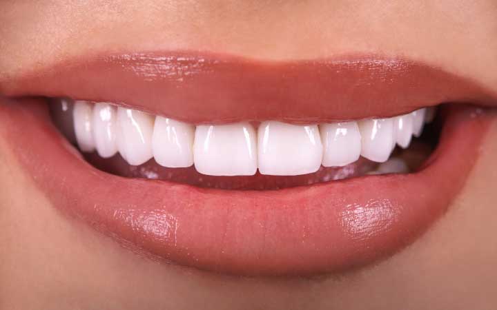Dental Veneers in Lahore | Dental Surgeons high quality nature looking porcelain veneers at Dental Surgeons Gulberg Lahore