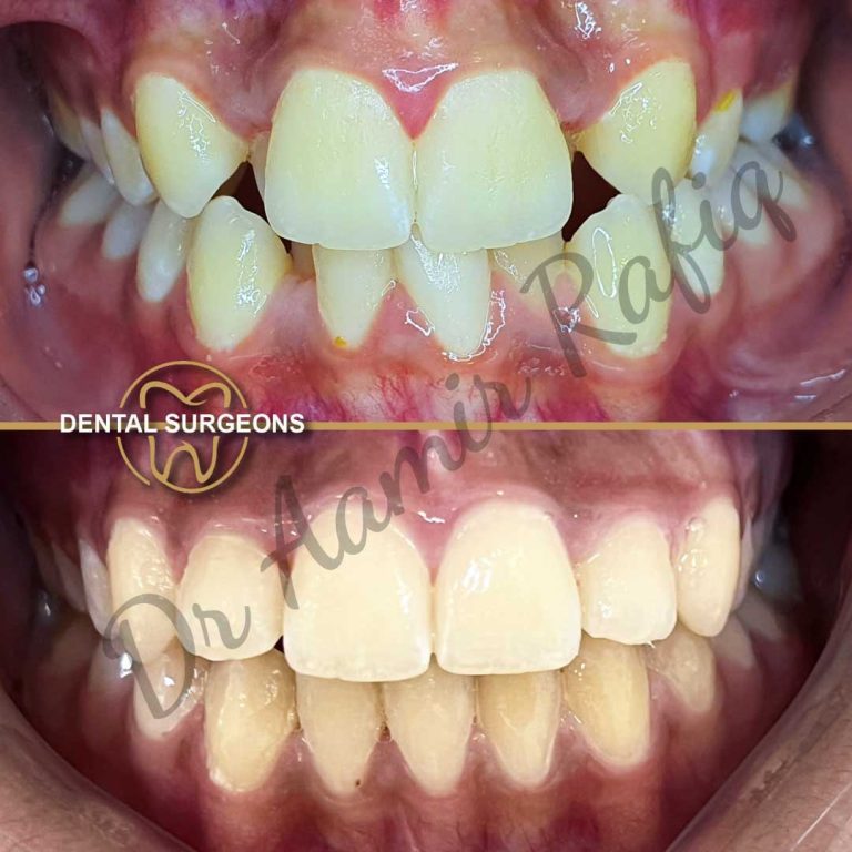 Orthodontic Case 1 Dental Surgeons Clinic Lahore