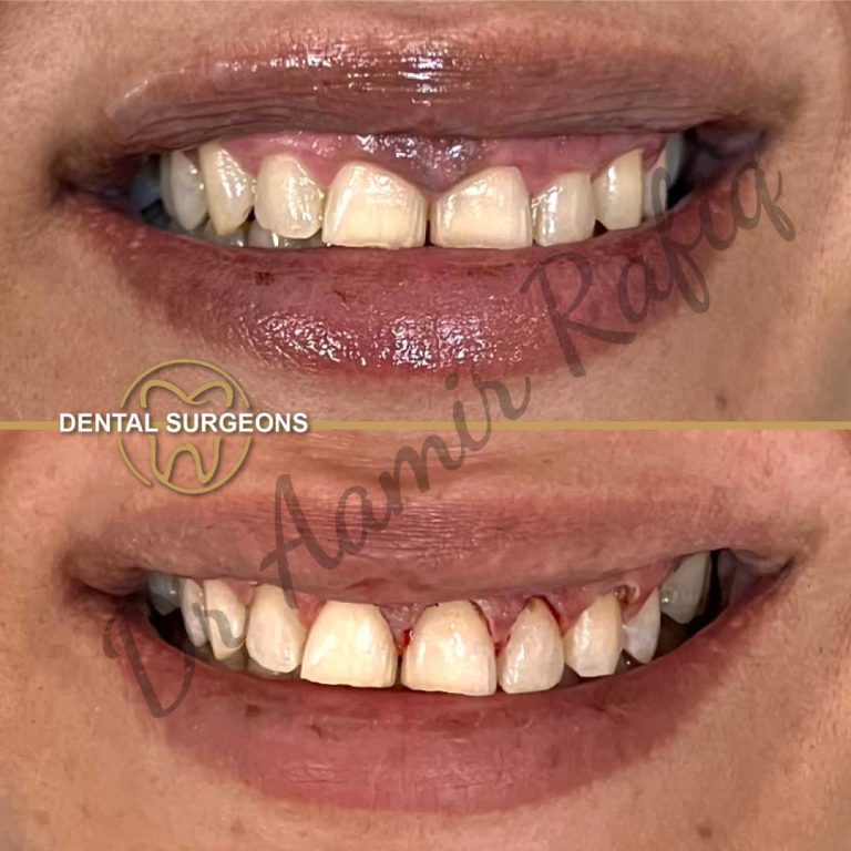 Gum Treatment case 1 Dental Surgeons clinic lahore