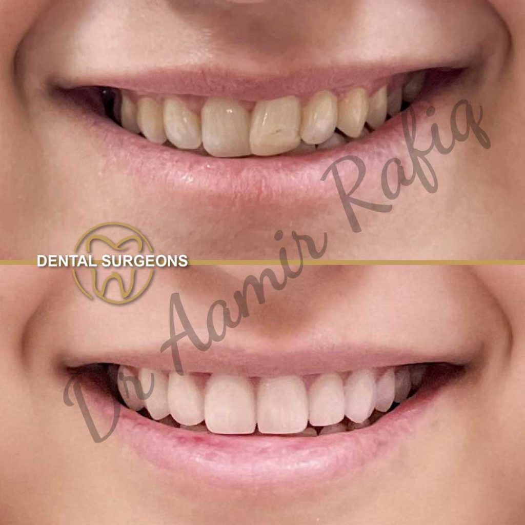 Dental Veneers in Lahore | Dental Surgeons veneers Case 1 Dental Surgeons Lahore