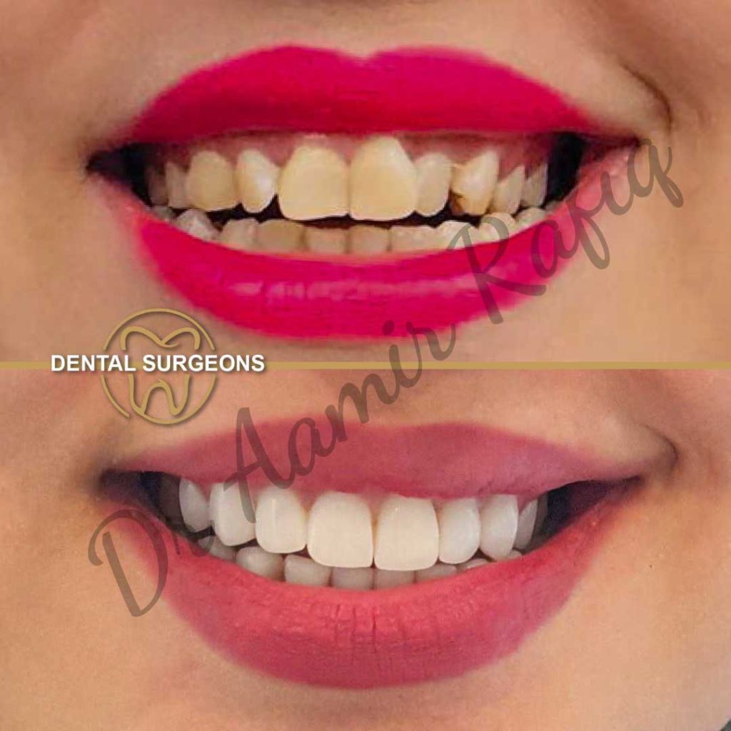 Dental Veneers in Lahore | Dental Surgeons veneers Case 3 Dental Surgeons Lahore