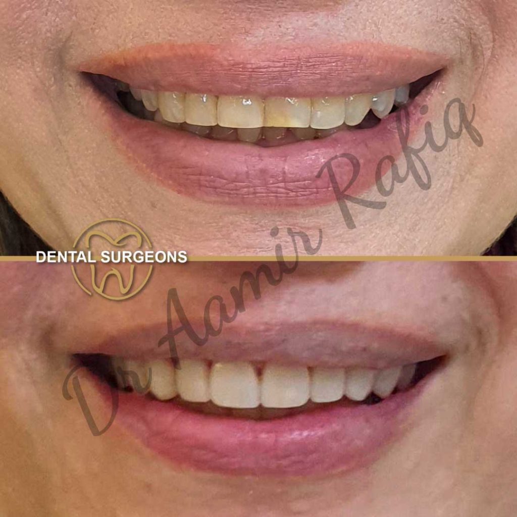 Dental Veneers in Lahore | Dental Surgeons veneers Case 4 Dental Surgeons Lahore