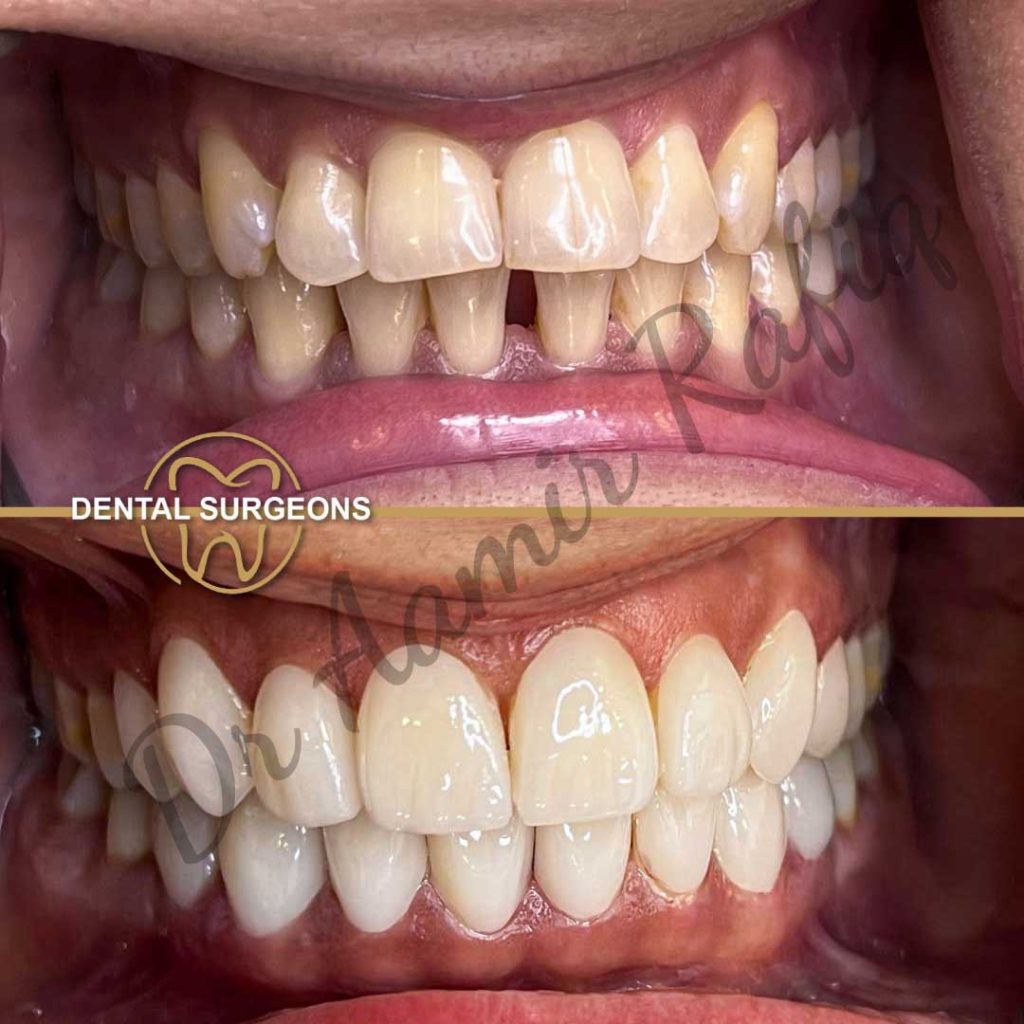 Dental Veneers in Lahore | Dental Surgeons veneers Case 5 Dental Surgeons Lahore