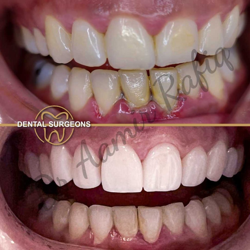 Dental Veneers in Lahore | Dental Surgeons veneers Case 6 Dental Surgeons Lahore