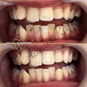 Teeth Bleaching, Whitening Dentist & Scaling and Polishing Scaling polishing case 1 Dental Surgeons clinic lahore