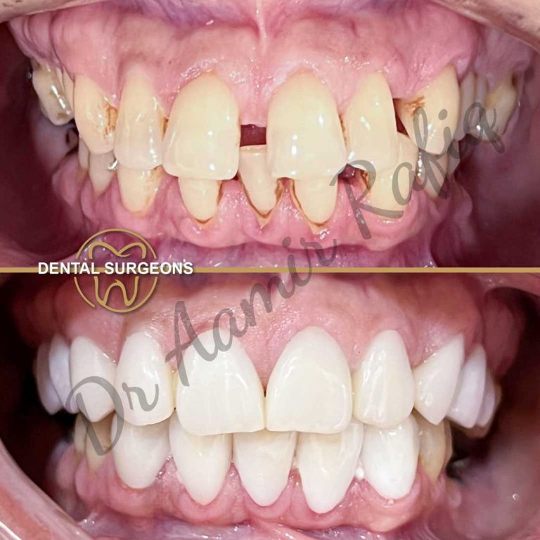 Full mouth rehabilitation, smile makeover case 1 Dental Surgeons Clinic Lahore