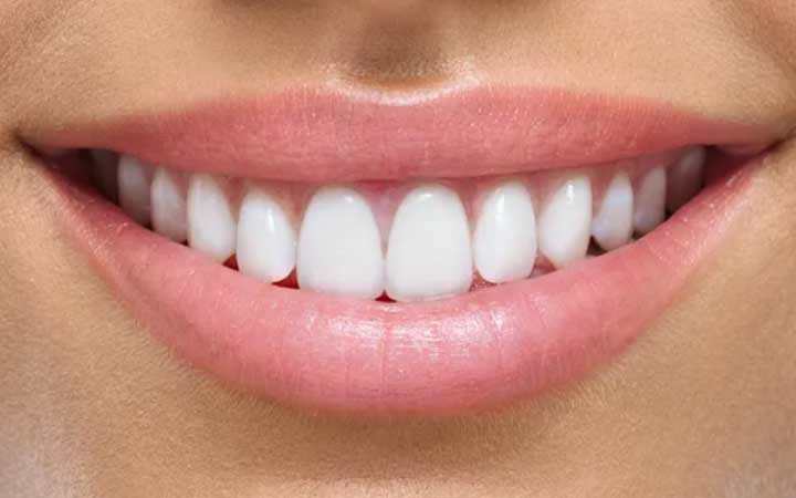 Dental Veneers in Lahore | Dental Surgeons lumineers at Dental Surgeons Gulberg Lahore