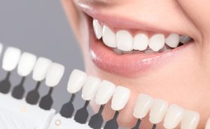 dental Veneers at Dental Surgeons Gulberg Lahore