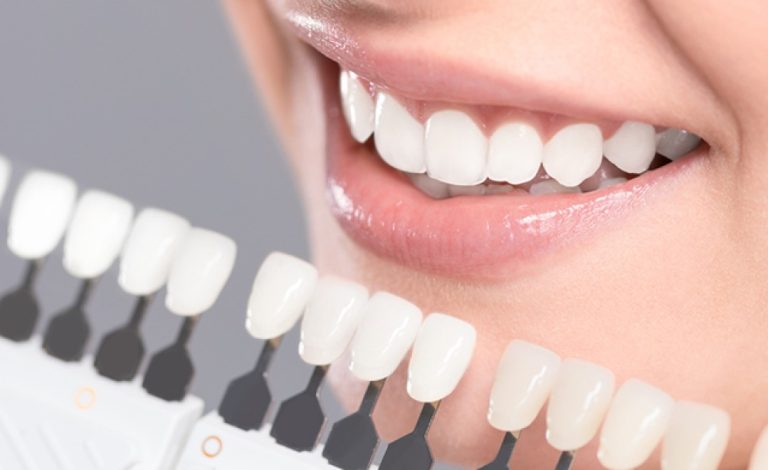 Dental Veneers in Lahore | Dental Surgeons dental Veneers at Dental Surgeons Gulberg Lahore