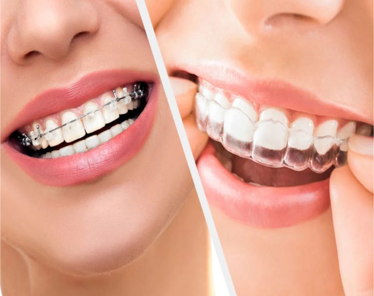 Braces & Aligners in Lahore | Best Orthodontic Treatment in Pakistan Braces Vs Aligners