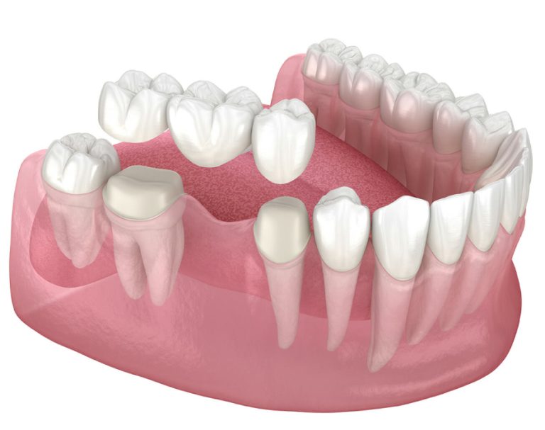 Dental bridges Treatment at Dental Surgeons Clinic Lahore