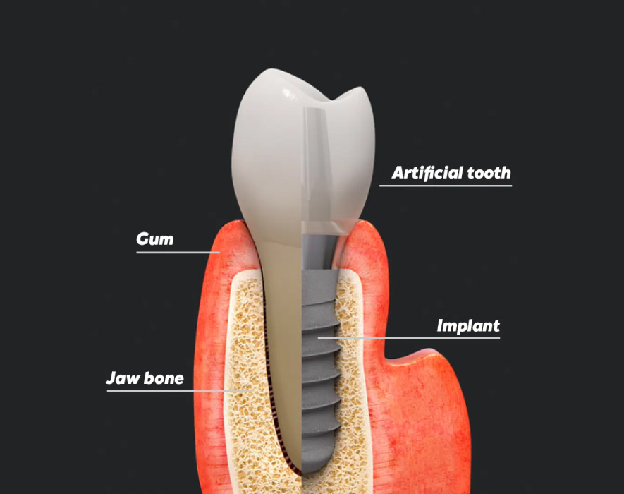 Dental Implants in Lahore | Best Dentists in Lahore Pakistan Dental Implant