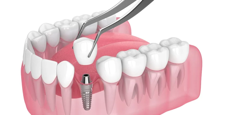 The Ultimate Guide to Dental Implants in Pakistan: Cost, Procedure, and Implantation Dentistry Benefits Quality Dental Implants in Lahore Pakistan