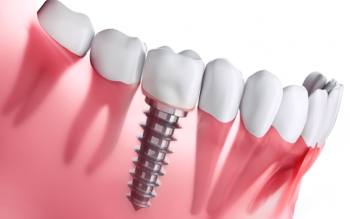 Dental Implants in Lahore | Best Dentists in Lahore Pakistan Endosteal implants