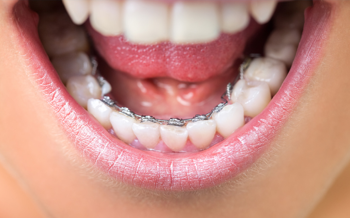 Braces & Aligners in Lahore | Best Orthodontic Treatment in Pakistan Lingual Braces at Dental Surgeons Lahore