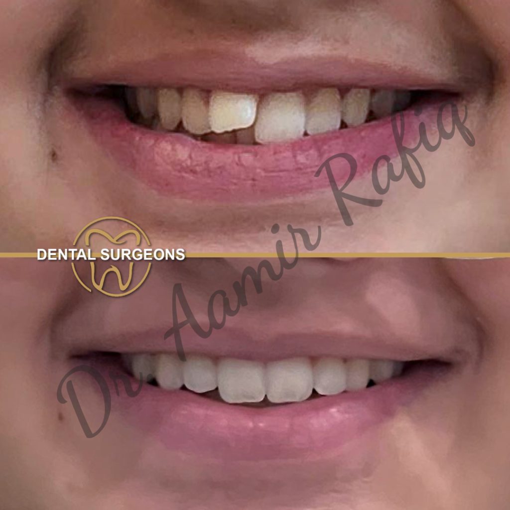 Braces & Aligners in Lahore | Best Orthodontic Treatment in Pakistan Ortho Treatment 1 at dental Surgeons Lahore Pakistan