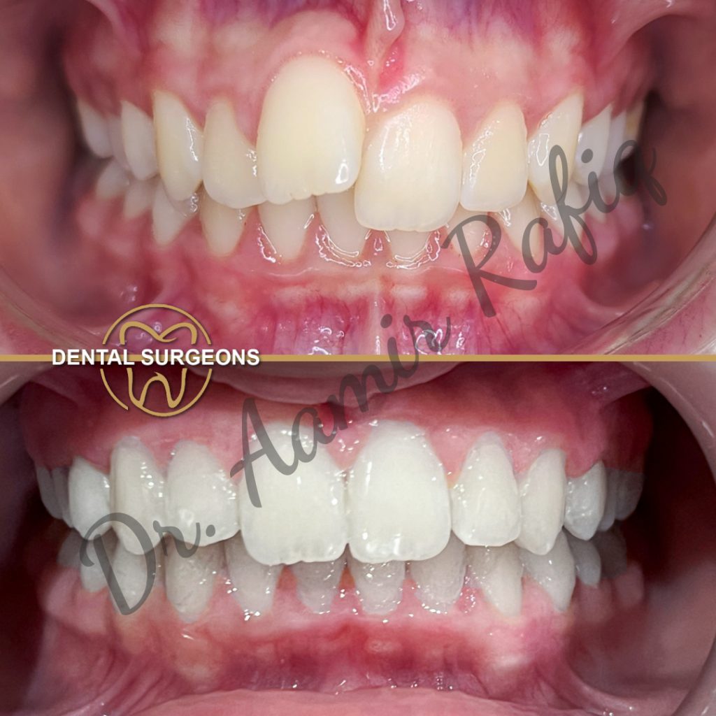 Braces & Aligners in Lahore | Best Orthodontic Treatment in Pakistan Ortho Treatment 2 at dental Surgeons Lahore Pakistan
