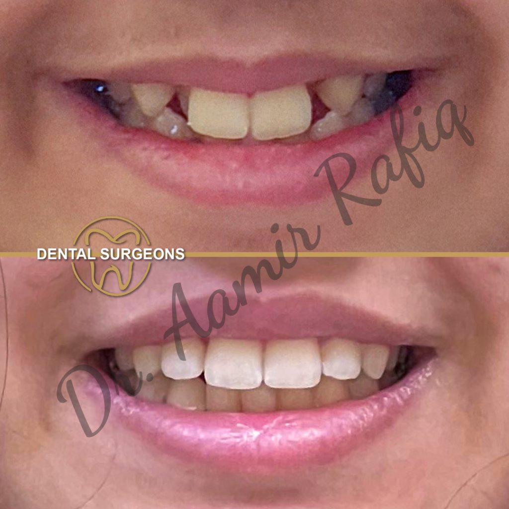 Braces & Aligners in Lahore | Best Orthodontic Treatment in Pakistan Ortho Treatment 3 at dental Surgeons Lahore Pakistan