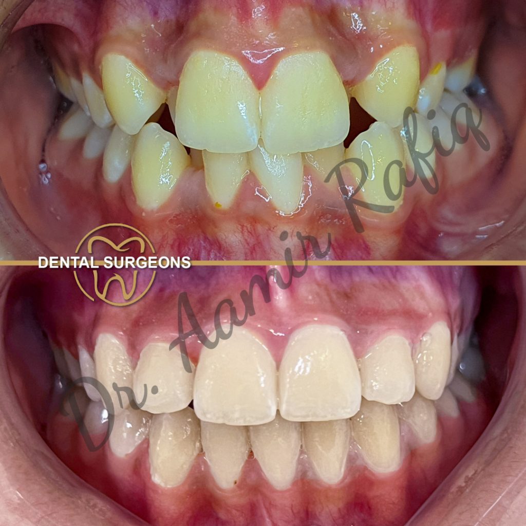 Braces & Aligners in Lahore | Best Orthodontic Treatment in Pakistan Ortho Treatment 4 at dental Surgeons Lahore Pakistan