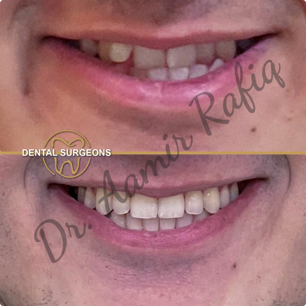 Braces & Aligners in Lahore | Best Orthodontic Treatment in Pakistan Ortho Treatment 5 at dental Surgeons Lahore Pakistan