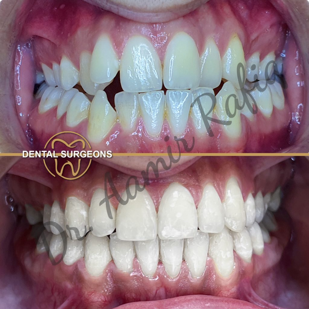 Braces & Aligners in Lahore | Best Orthodontic Treatment in Pakistan Ortho Treatment 6 at dental Surgeons Lahore Pakistan