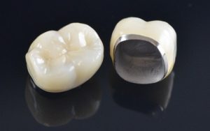 PFM Crown Dental Surgeons Lahore