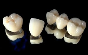 PFM Crown Dental Surgeons Lahore