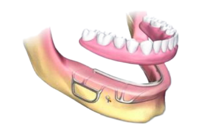 Dental Implants in Lahore | Best Dentists in Lahore Pakistan Subperiosteal implants