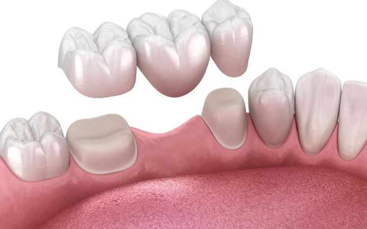 Traditional Bridges Treatment at Dental Surgeons Clinic Lahore