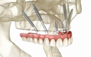 The Ultimate Guide to Dental Implants in Pakistan: Cost, Procedure, and Implantation Dentistry Benefits Zygomatic Implant
