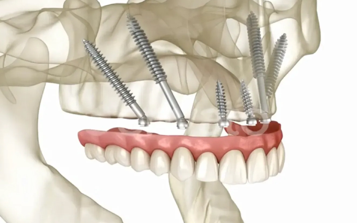 Dental Implants in Lahore | Best Dentists in Lahore Pakistan Zygomatic Implant