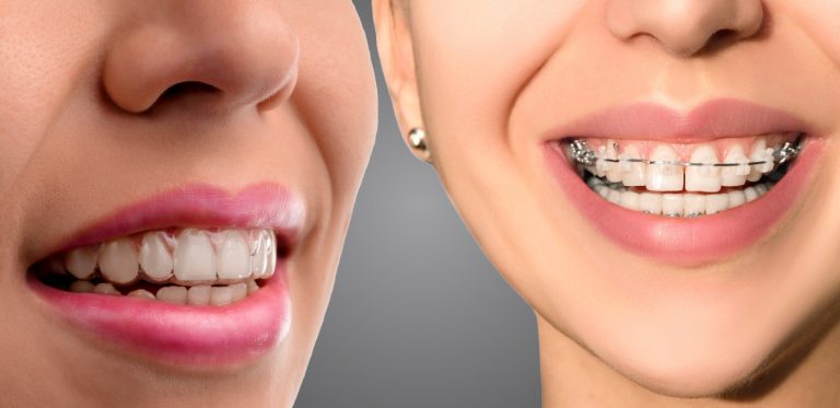 Braces Vs Aligners Dental Surgeons Clinic Gulberg Lahore