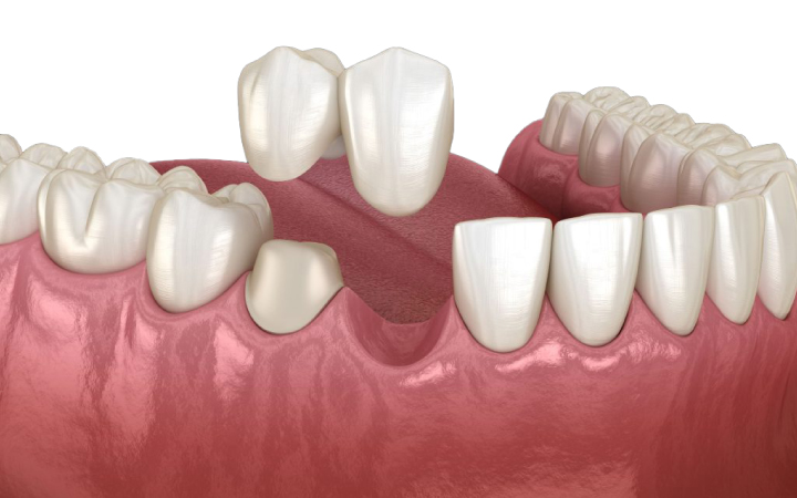 Cantilever Bridges Treatment at Dental Surgeons Clinic Lahore