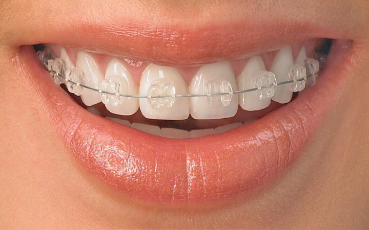 Braces & Aligners in Lahore | Best Orthodontic Treatment in Pakistan Ceramic Braces at Dental Surgeons Lahore