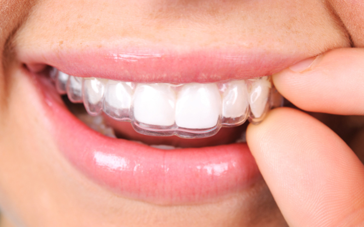 Braces & Aligners in Lahore | Best Orthodontic Treatment in Pakistan Clear Aligners at Dental Surgeons Lahore