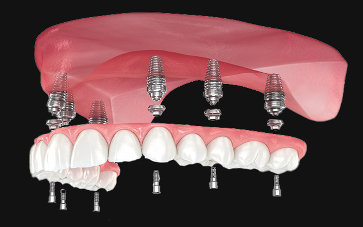Best Dentures Treatment in Lahore Implant Supported Dentures All on x Dentures treatment at Dental surgeons Lahore