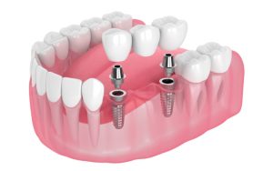 Implant Supported Bridges Treatment at Dental Surgeons Clinic Lahore