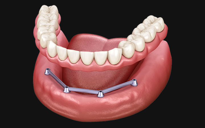 Best Dentures Treatment in Lahore Implant Supported Dentures treatment at Dental surgeons Lahore