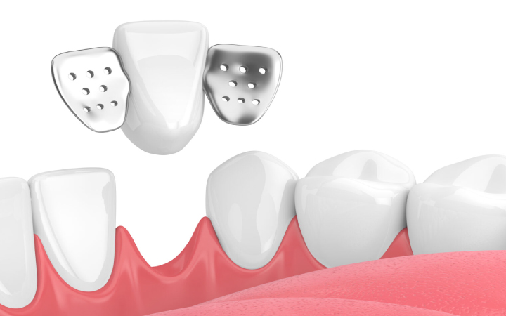 Maryland Bridges Treatment at Dental Surgeons Clinic Lahore