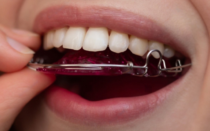 Braces & Aligners in Lahore | Best Orthodontic Treatment in Pakistan Retainer at Dental Surgeons Lahore