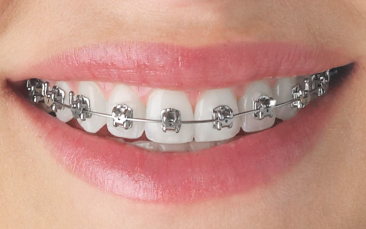 Braces & Aligners in Lahore | Best Orthodontic Treatment in Pakistan Self Ligating Braces at Dental Surgeons Lahore