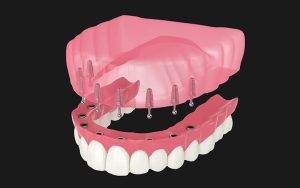Implant Retained Dentures treatment at Dental surgeons Lahore
