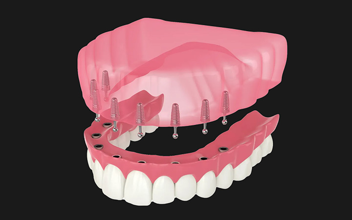 Best Dentures Treatment in Lahore Implant Retained Dentures treatment at Dental surgeons Lahore