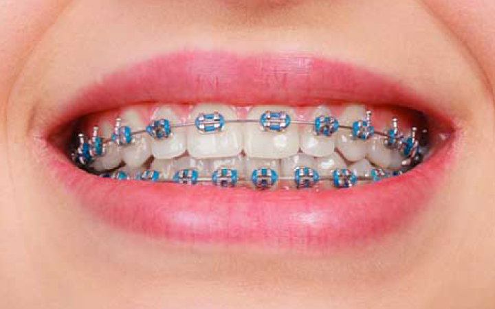 Braces & Aligners in Lahore | Best Orthodontic Treatment in Pakistan Metal Braces at Dental Surgeons Lahore