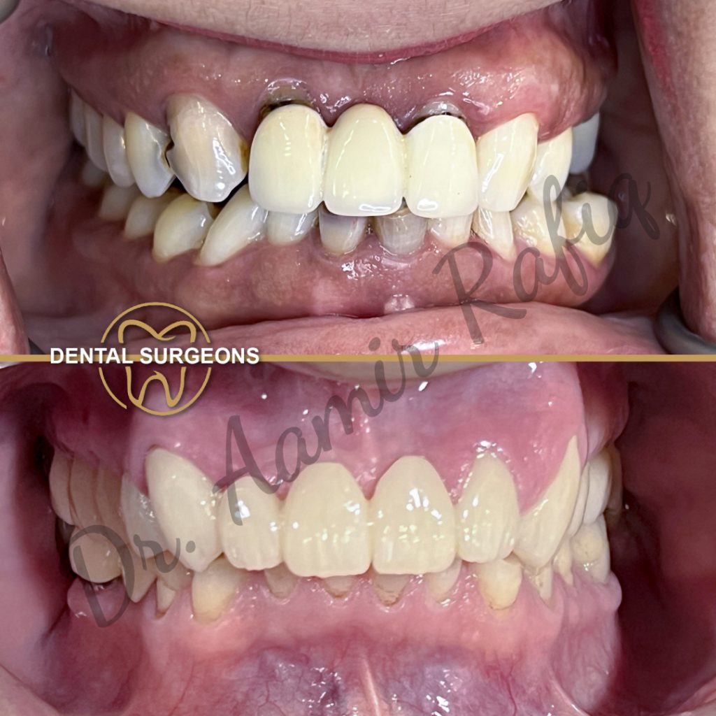 Zirconia Crown Treatment Patient 4 at dental surgeons Clinic Lahore Pakistan