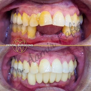 Zirconia Crown Treatment Patient 5 at dental surgeons Clinic Lahore Pakistan