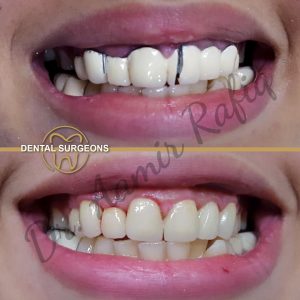 Zirconia Crown Treatment Patient 2 at dental surgeons Clinic Lahore Pakistan