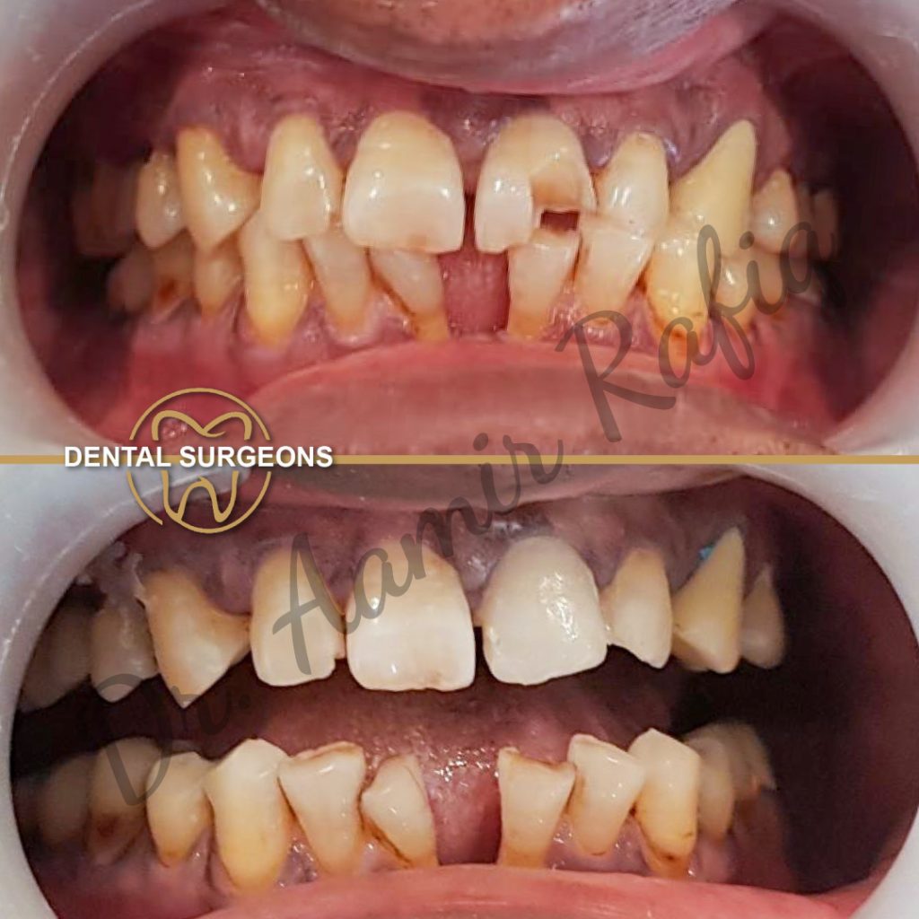 Zirconia Crown Treatment Patient 3 at dental surgeons Clinic Lahore Pakistan